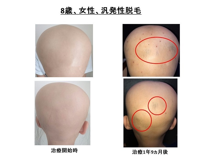 円形脱毛症　病院